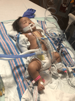 Photo of baby with heart monitors
