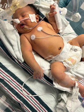 photo of baby in NICU