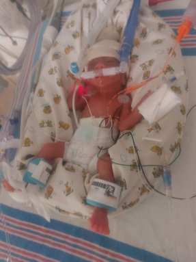 premature baby in an incubator